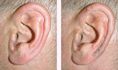 Epilazione dell'orecchio