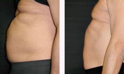 Thermage addome