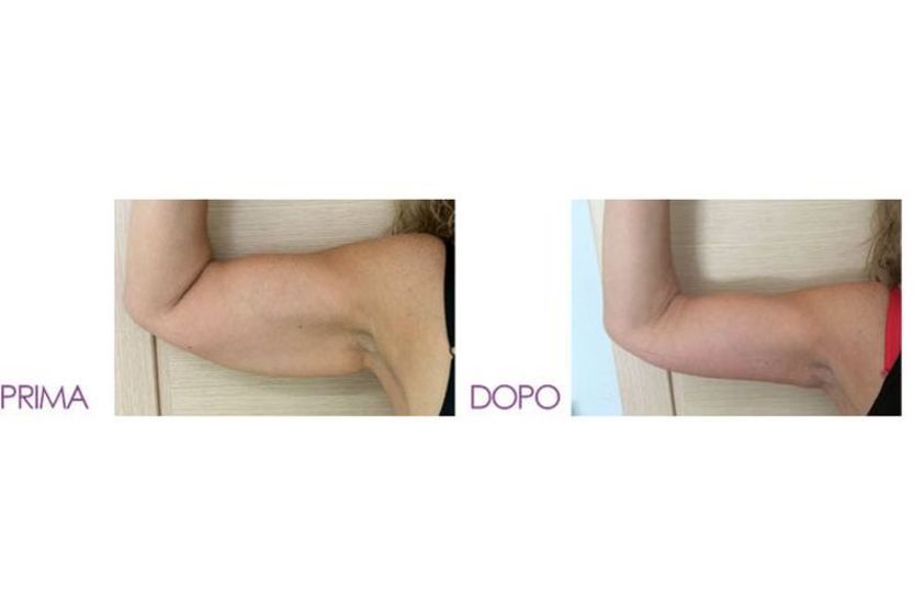 Liposcultura prima e dopo - 767719