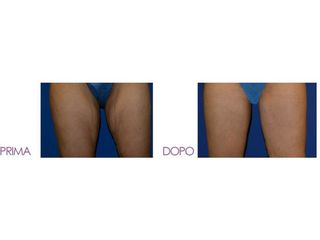 Lifting gambe prima dopo