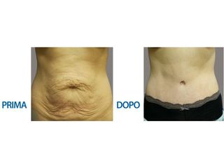 Torsoplastica prima e dopo