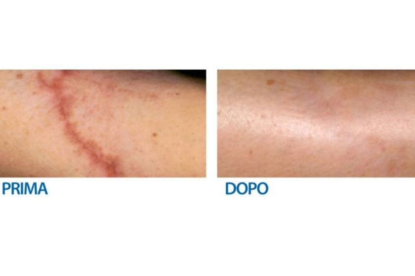 Cicatrici prima e dopo - 767730