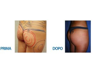 Lipofilling prima e dopo