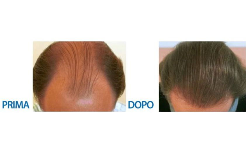 Trapianto capelli prima e dopo - 767733