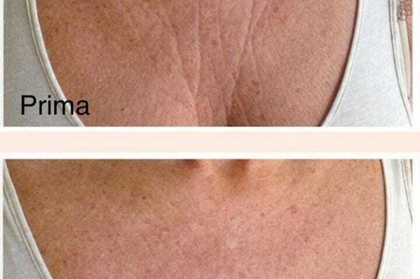 Rughe prima e dopo - 797668