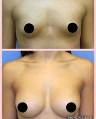 Mastoplastica additiva - Dott. Massimiliano Sparacello - Novamedis Day Surgery