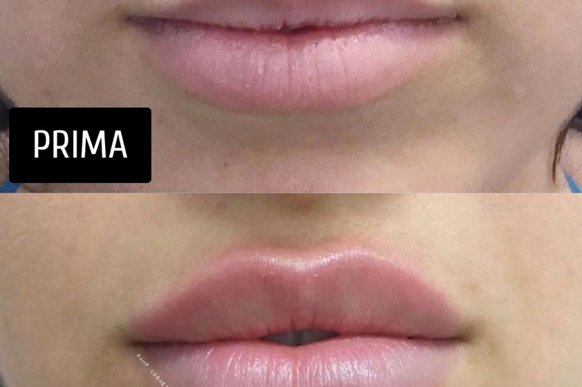 Filler labbra prima e dopo - 839479