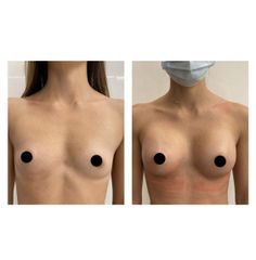Mastoplastica additiva - Dott. Massimiliano Sparacello - Novamedis Day Surgery
