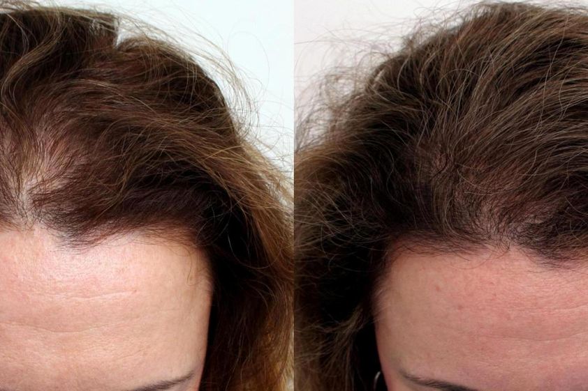 Trapianto capelli prima e dopo - 839481