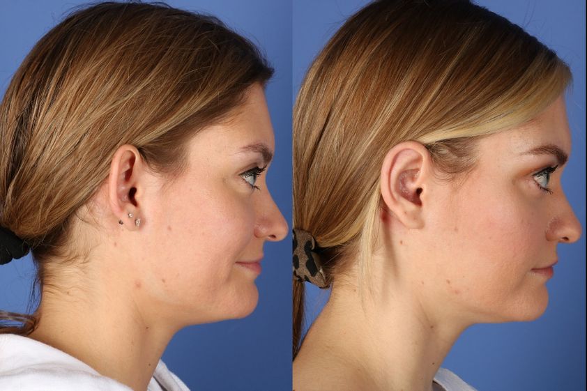 Otoplastica prima e dopo - 839484