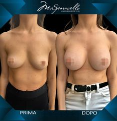 Mastoplastica additiva - Dott. Massimiliano Sparacello - Novamedis Day Surgery