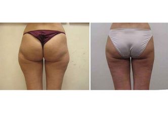 Liposuzione prima e dopo