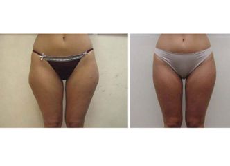 Liposuzione prima e dopo