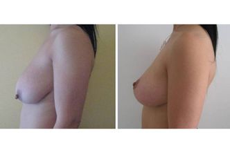 Mastopessi prima e dopo