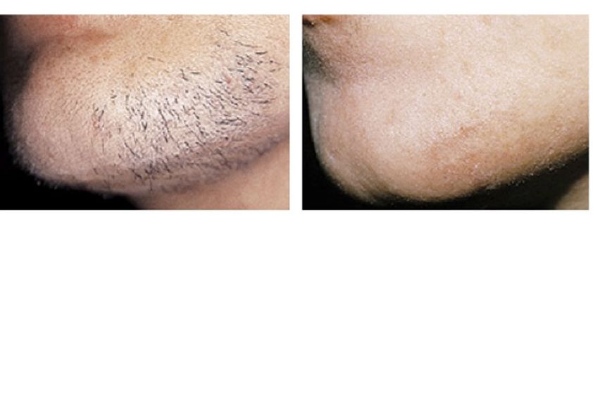 Depilazione laser prima e dopo - 746219