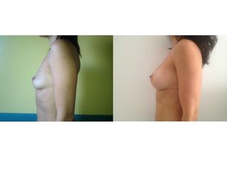 Mastoplastica additiva pre e post
