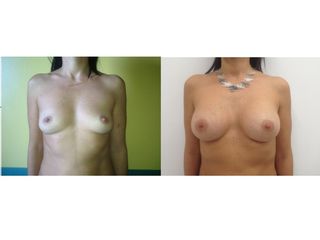 Mastoplastica additiva pre e post