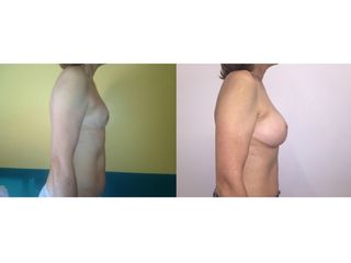 Mastoplastica additiva pre e post