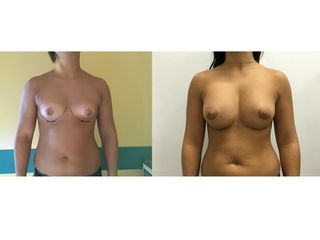 Mastoplastica additiva pre e post
