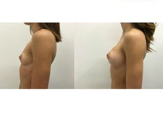 Mastoplastica additiva pre e post