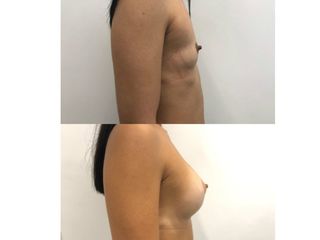 Mastoplastica additiva pre e post