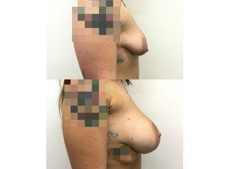 Mastoplastica additiva pre e post