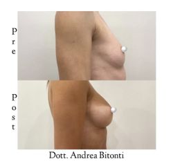 Mastoplastica additiva pre e post