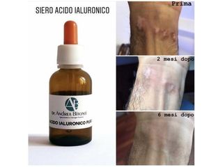 Acido ialuronico  - Dott. Andrea Bitonti