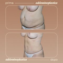 Addominoplastica - Dott. Antonio Vernillo