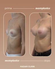 Dott. Antonio Vernillo Mastoplastica additiva