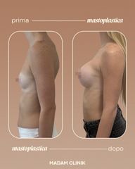Dott. Antonio Vernillo Mastoplastica additiva