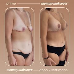 Dott. Antonio Vernillo Mommy makeover