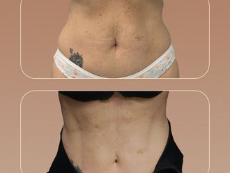Liposcultura prima e dopo - 879061