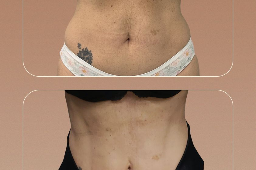 Liposcultura prima e dopo - 879061
