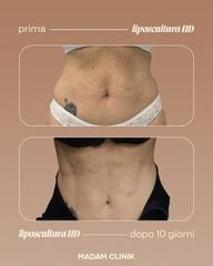 Dott. Antonio Vernillo Liposcultura HD