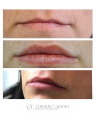 Aumento labbra con filler - Dr. Antonio Capraro