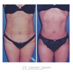 Addominoplastica + liposuzione fianchi - Dr. Antonio Capraro