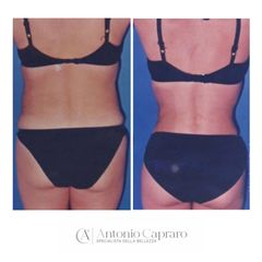 Addominoplastica + liposuzione dei fianchi + lipo filling glutei - Dr. Antonio Capraro