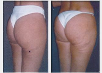 Cellulite prima dopo
