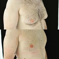Ginecomastia - Dott. Emilio Trignano