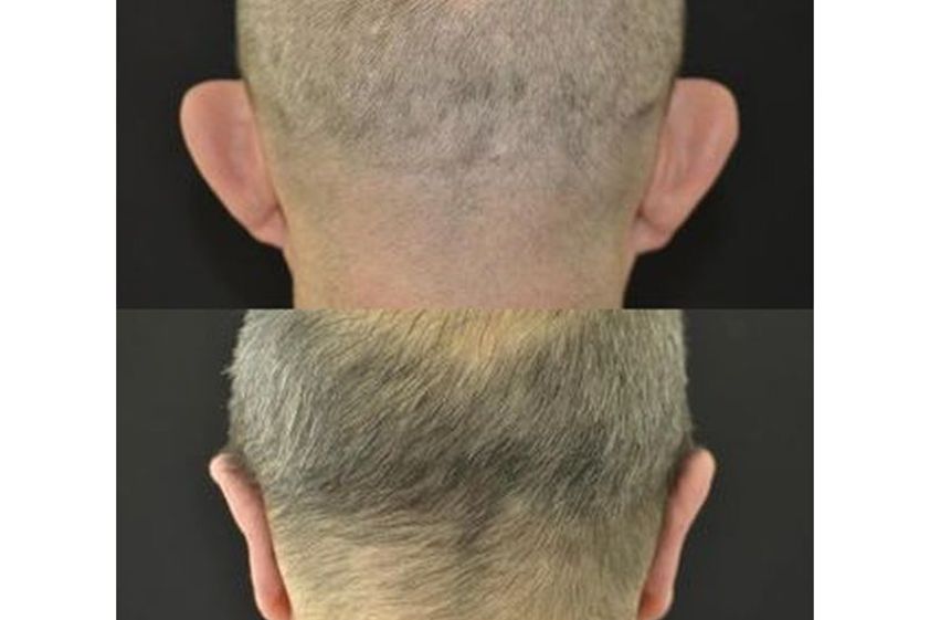 Trapianto capelli prima e dopo - 813942