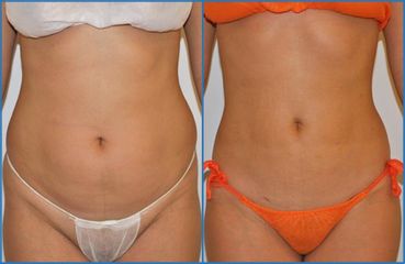Liposuzione prima e dopo