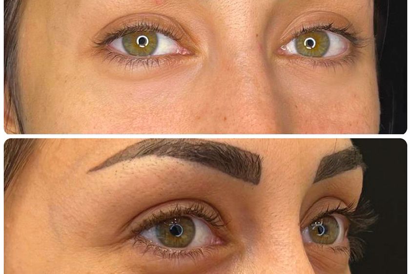 Eliminare occhiaie prima e dopo - 869863