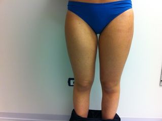 Liposuzione post