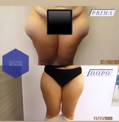 Vaserlipo - Dott. ALFIO SCALISI - 4 Spa Medical Clinic