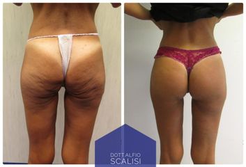 Gluteoplastica - Dott. ALFIO SCALISI - 4 Spa Medical Clinic