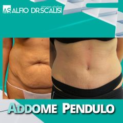 Addominoplastica . Dott. ALFIO SCALISI - 4 Spa Medical Clinic