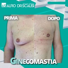 Ginecomastia - Dott. ALFIO SCALISI - 4 Spa Medical Clinic