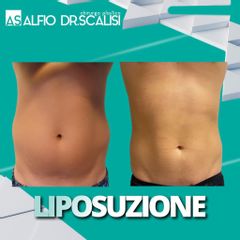 Liposuzione - Dott. ALFIO SCALISI - 4 Spa Medical Clinic