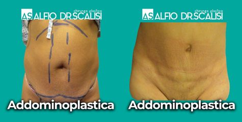 Addominoplastica - Dott. ALFIO SCALISI - 4 Spa Medical Clinic